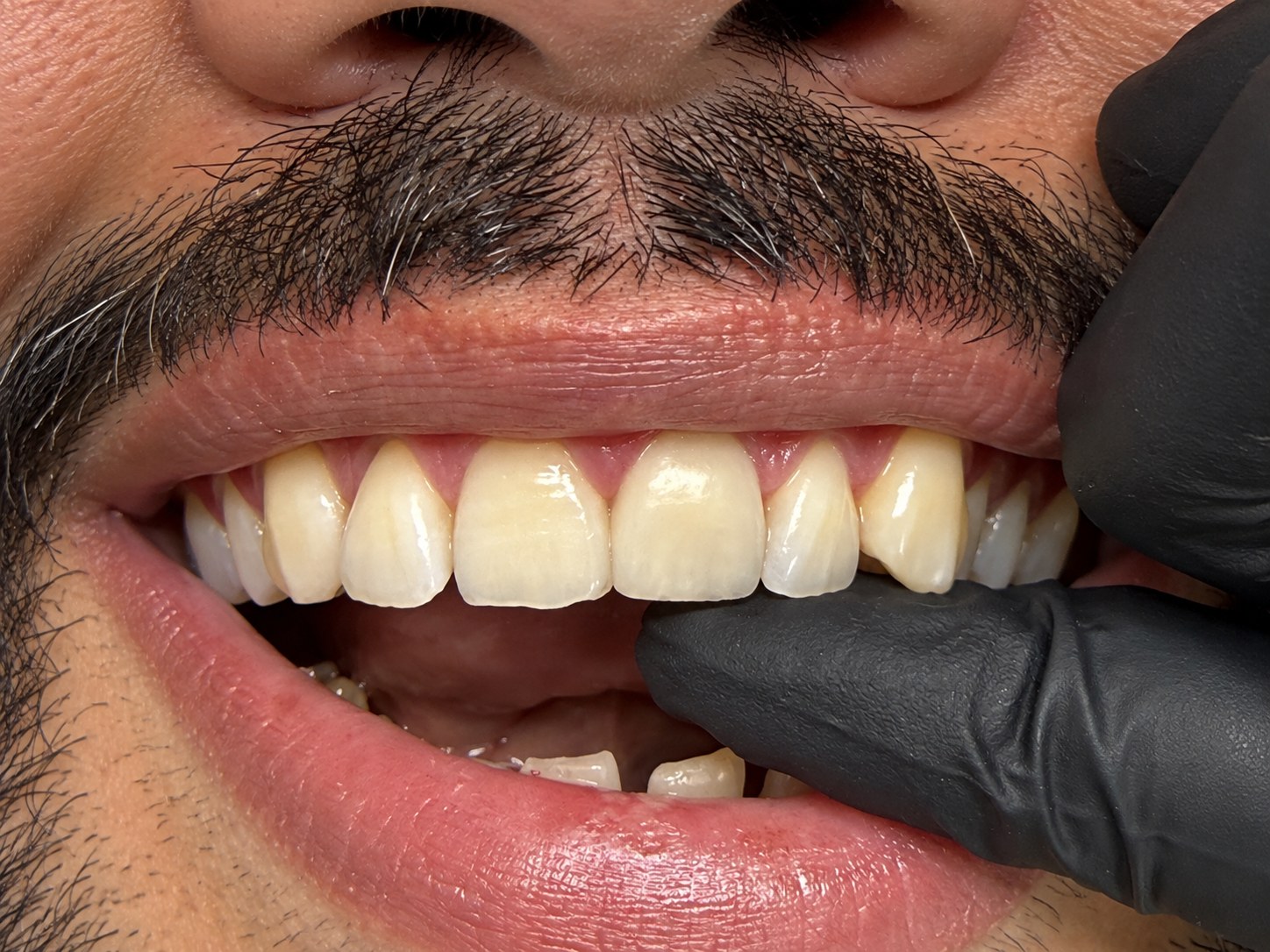 Después - Transformación Estética de Sonrisa