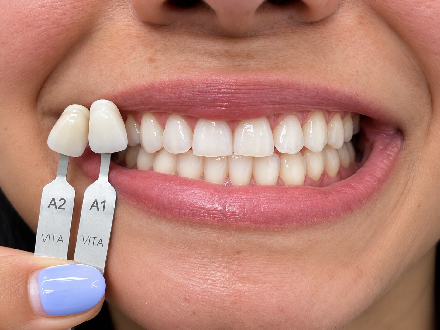 Después - Aclaramiento Estético Dental