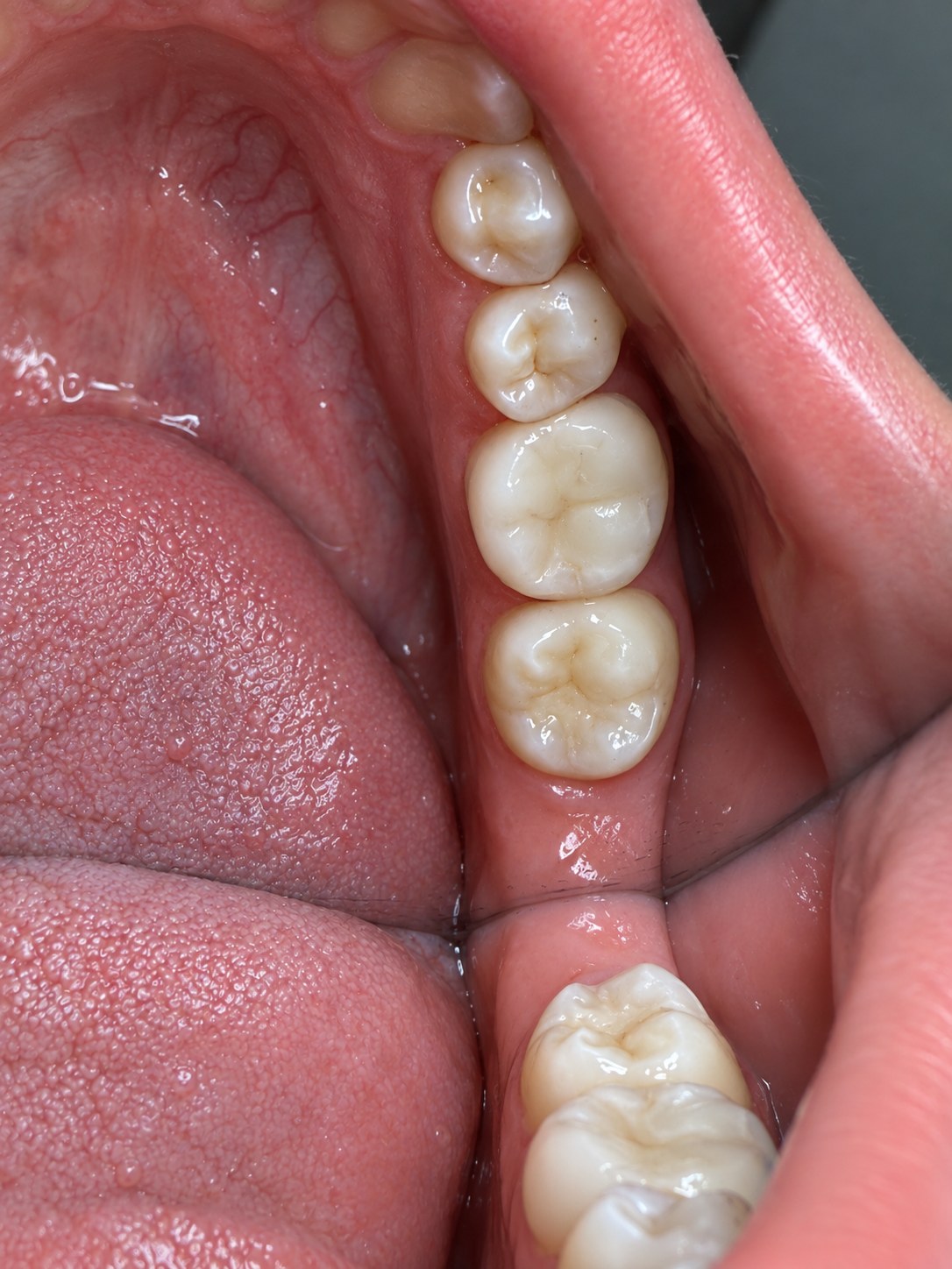 Después - Tratamiento y Restauración de Caries