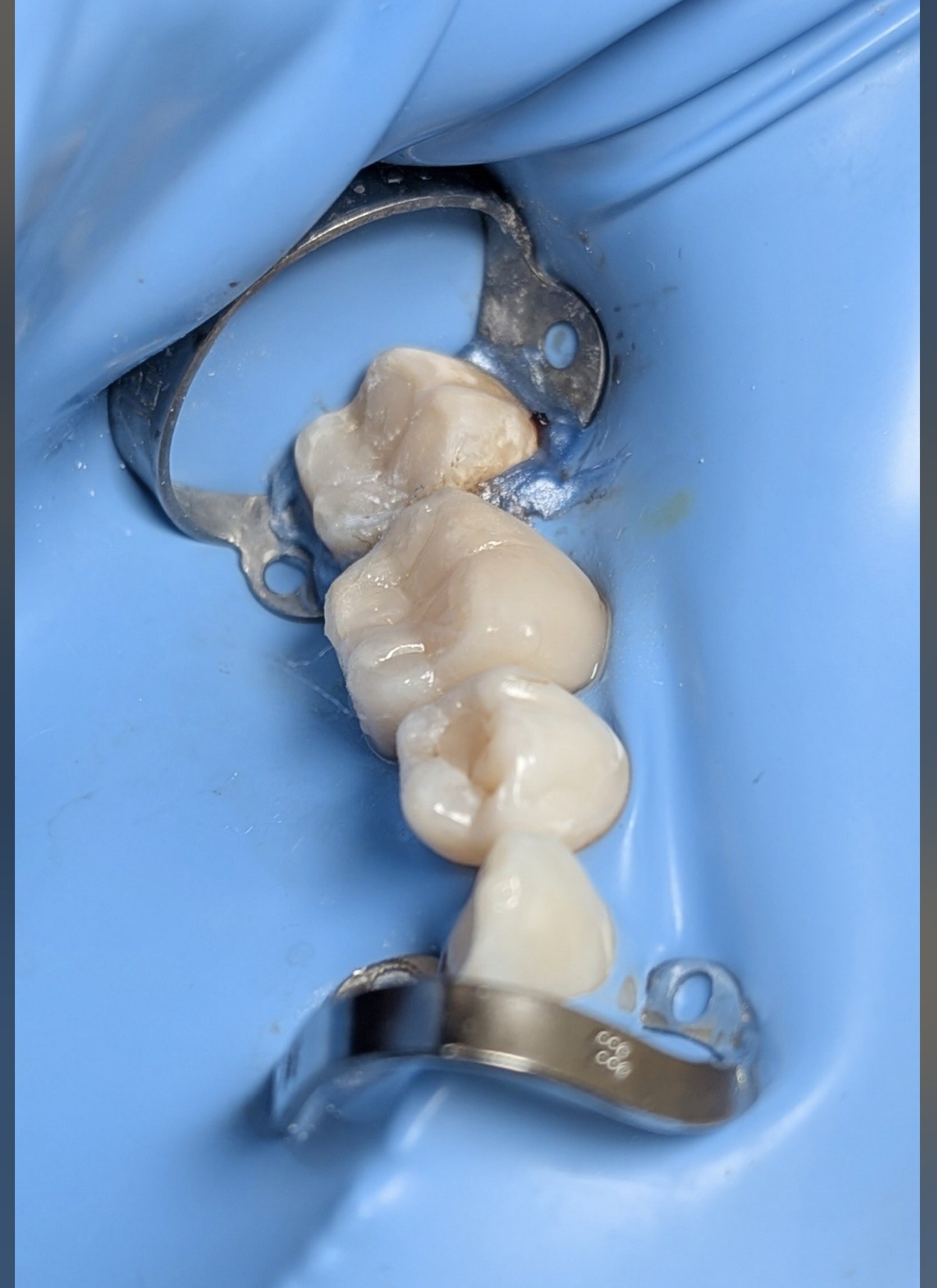 Después - Alineación Dental con Ortodoncia