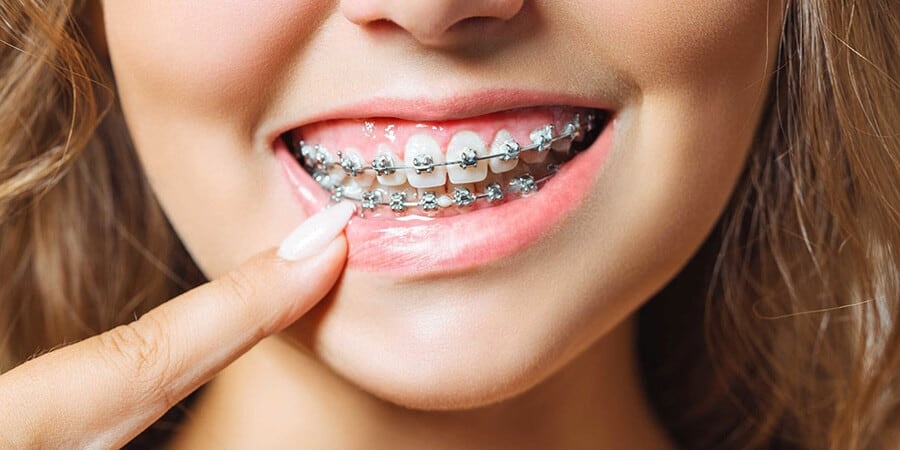 Brackets autoligables