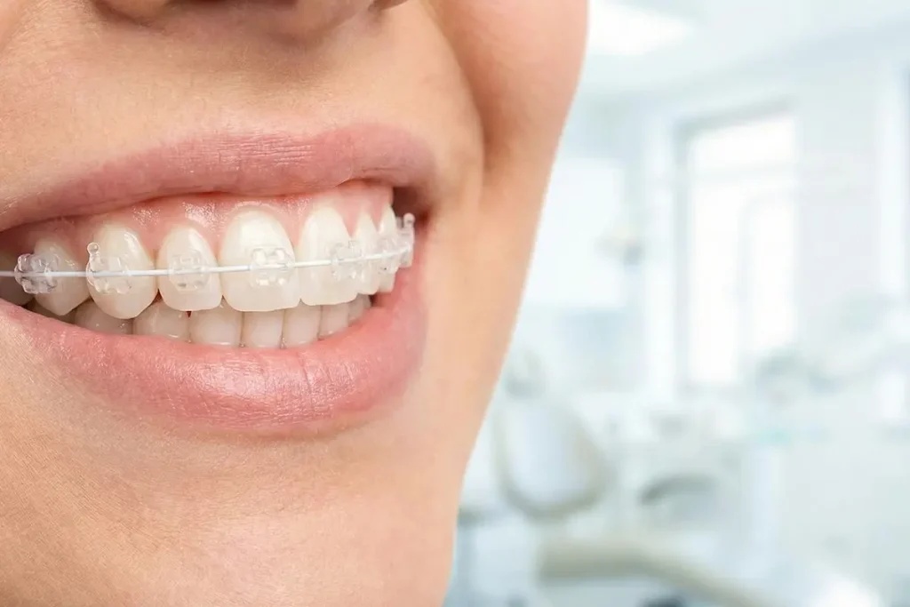 Brackets de zafiro